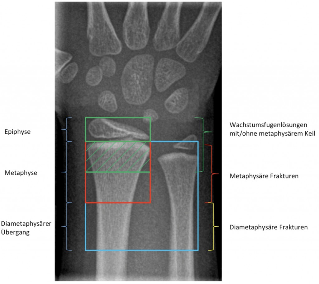 CMEArtikel Distale Radiusfrakturen im Kindesalter Sinn und Unsinn