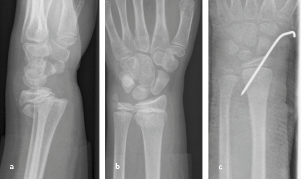 CME-Artikel: Distale Radiusfrakturen im Kindesalter – Sinn und Unsinn in der Versorgung - BDC|Online