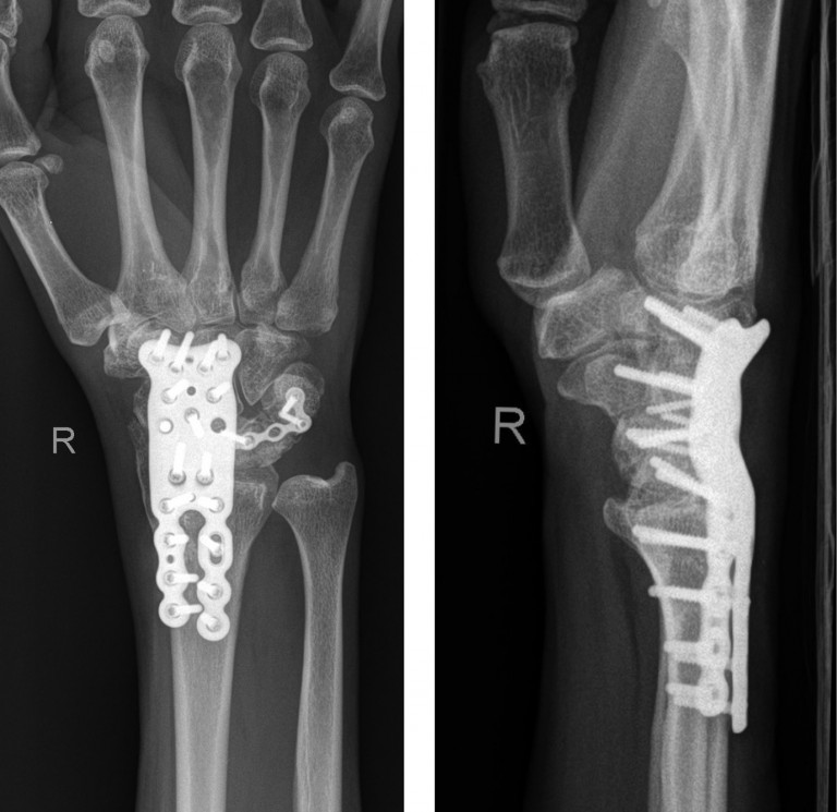 Arthrodesen in der Hand – Neue Therapieverfahren - BDC|Online