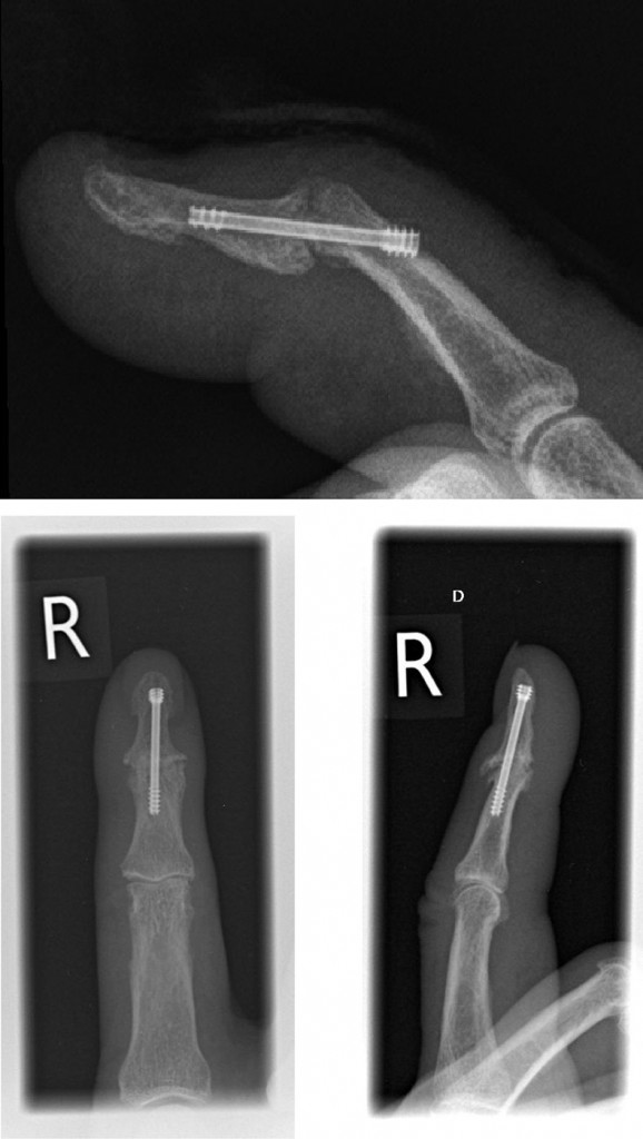 Arthrodesen in der Hand – Neue Therapieverfahren - BDC|Online